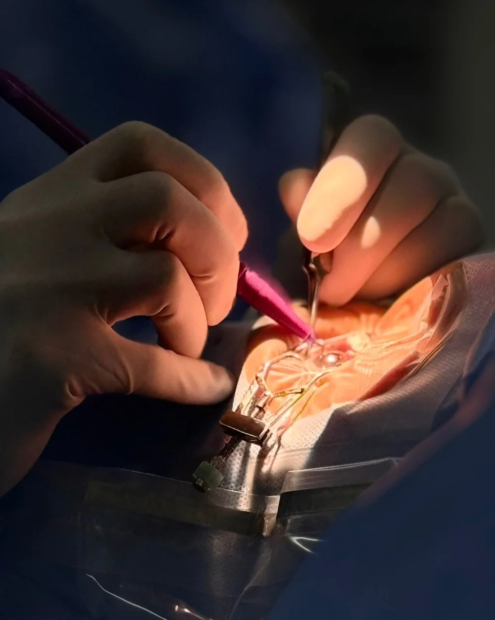 Tratamento de Ceratocone — Dra. Bianca Susanna